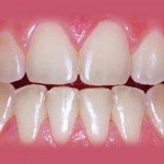 Clareamento dental - Antes