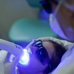 Clareamento dental a Laser
