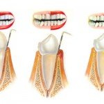 Cirurgia para eliminação ou tratamento da bolsa periodontal