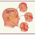 Áreas da face inervadas pelas 3 ramificações do nervo trigêmeo