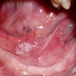 Lesão branca em assoalho bucal em paciente alcoólatra de 55 anos. Diagnóstico de CARCINOMA (Câncer bucal) realizado através de biópsia EXCISIONAL.