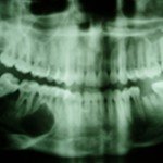 Radiografia panorâmica: imagem radiolúcida do lado D mostra extensa lesão osteolítica associada à reabsorção dentária, sugestivo de AMELOBLASTOMA