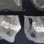 Tomografia computadorizada: revela caráter destrutivo e dimensões da lesão óssea