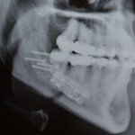Radiografia lateral após a cirurgia