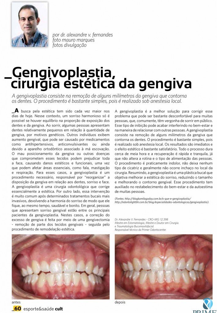 Cult 96 – Gengivoplastia, cirurgia estética da gengiva